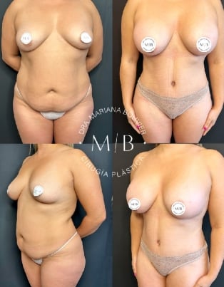 Resultado antes y después de dermolipectomía y liposucción